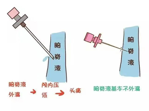 麻醉手術(shù)后不需要去枕平臥了 你知道嗎？