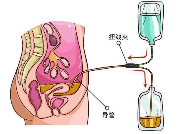 優(yōu)勢學(xué)科｜腎臟替代治療——醫(yī) 護 患一體化腹膜透析管理模式