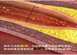 特色門診 | 頸動脈斑塊專科門診