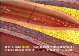 特色門診 | 頸動(dòng)脈斑塊?？崎T診
