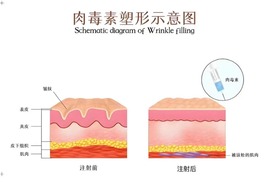 健康科普|肉毒素注射：既能抗衰又有風(fēng)險？一篇看懂它的 “能” 與 “不能”