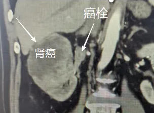 優(yōu)勢(shì)技術(shù)|勇克“癌栓”難關(guān)——我院成功完成高難度右腎癌伴腎靜脈癌栓切除術(shù)